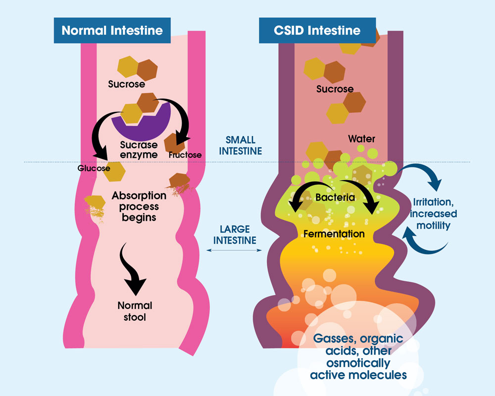 Read More About CSID A Carbohydrate Digestion Disorder